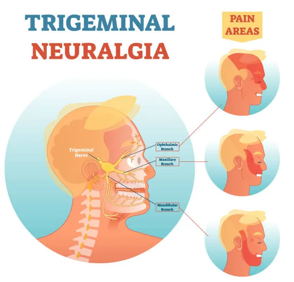 Trigeminal Neuralgia image 1