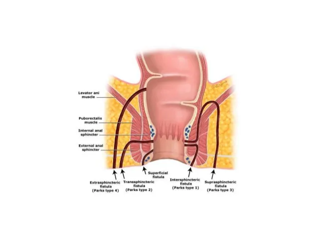 Fistula in Ano Surgery image 1