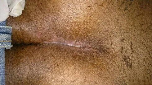 LASER Treatment Pilonidal Sinus  image 1