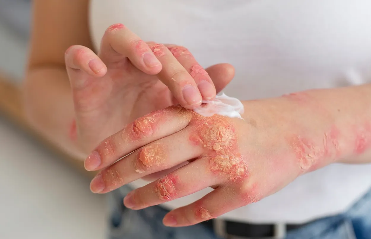 Consultation for skin, hair or nail diseases image 1