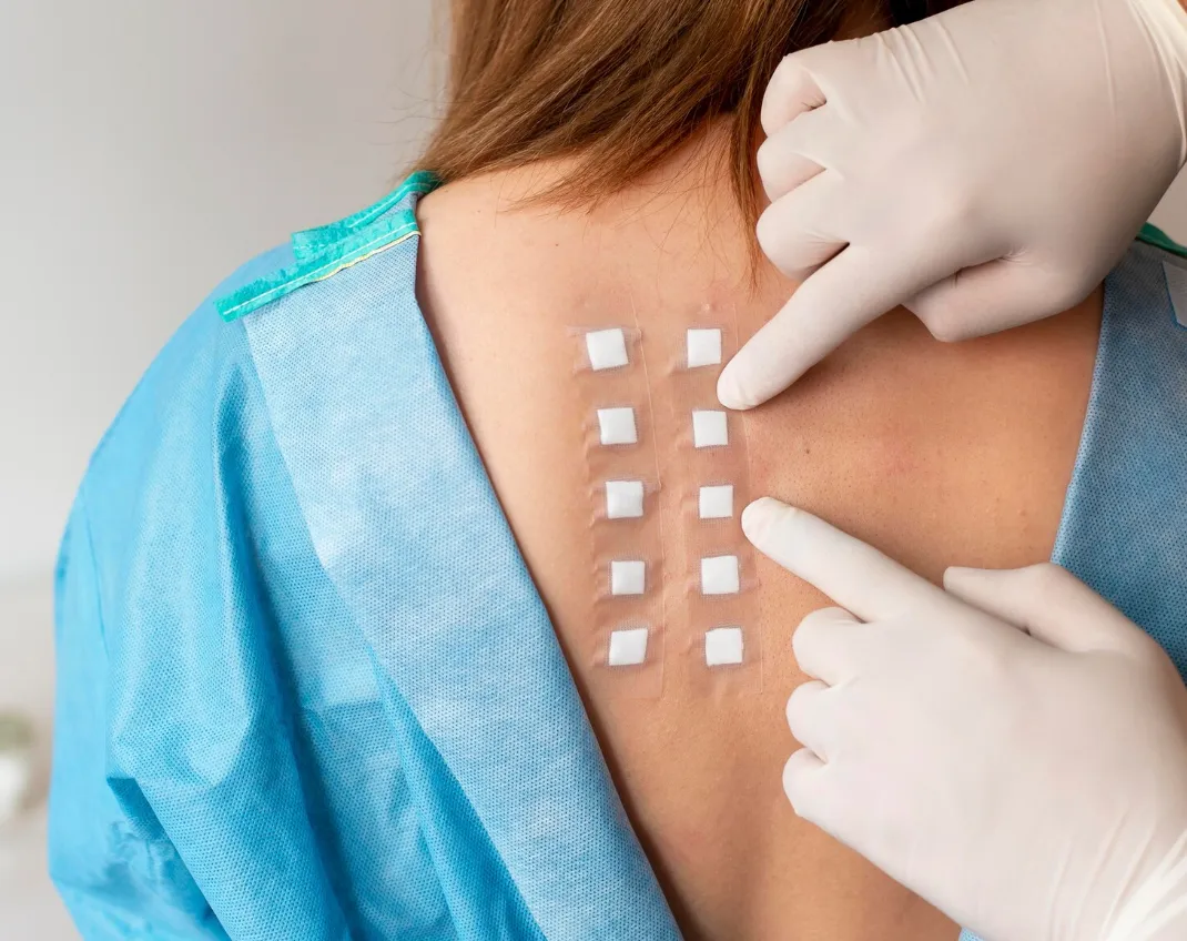 Patch Testing For Allergy image 1