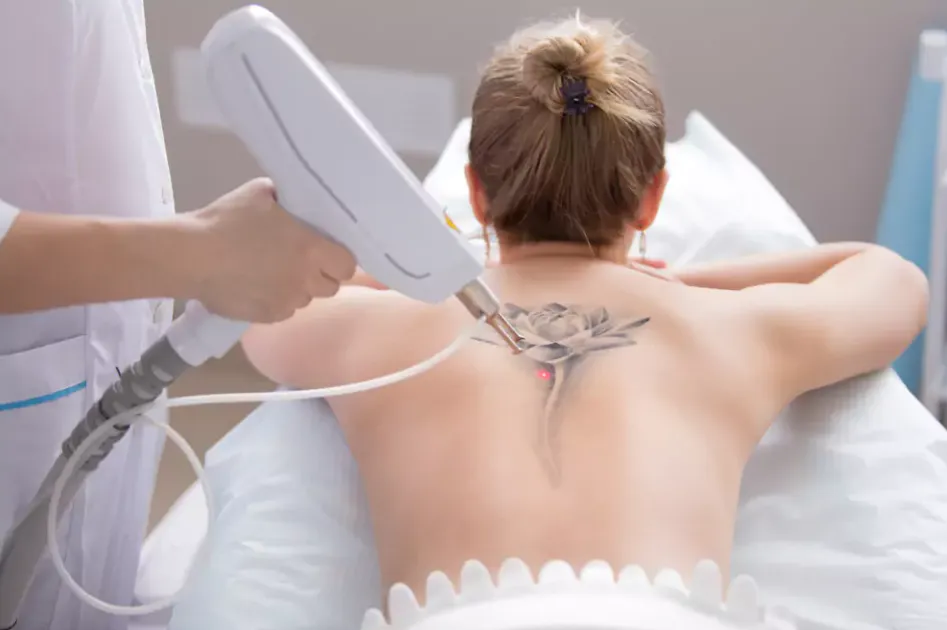 Tattoo Removal Laser image 1