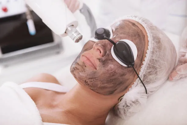 Carbon Laser Peel image 1