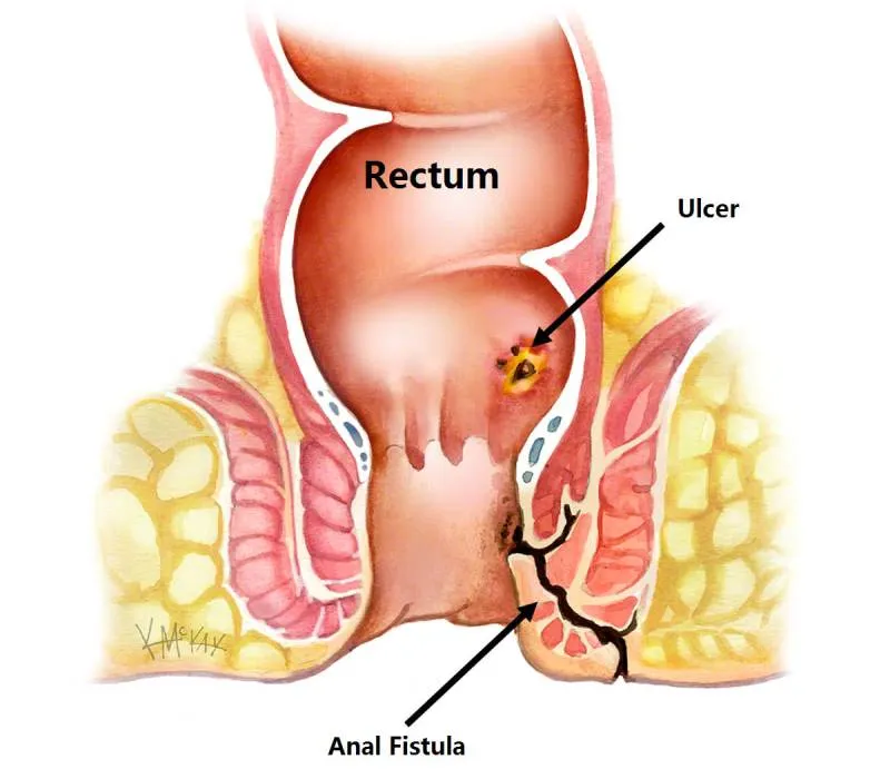 Fistula Treatment Specialist in Wakad, PCMC image 1