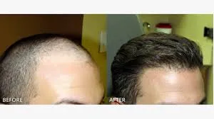  FUE HAIR TRANSPLANTATION  image 1