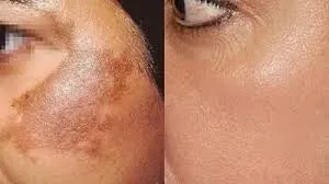 Pigmentation Treatment image 1