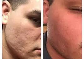  Skin Polishing Treatment image 1
