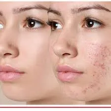  Anti Acne Treatment image 1