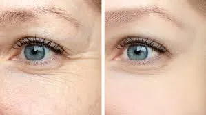 Under Eye Lifting Laser Treatment image 1