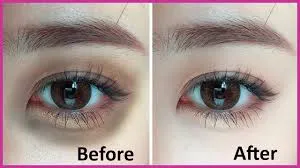 Anti Dark Circle Treatment image 1