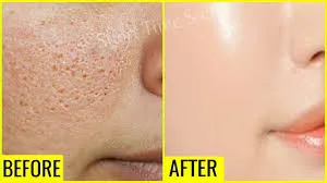 Anti Open Pore Treatment image 1