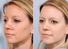 Laser Mole Remover Treatment image 1