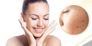 Pigmentation Treatment  image 1