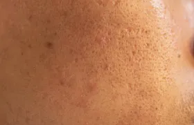 Open Pores Treatment In Coimbatore image 1