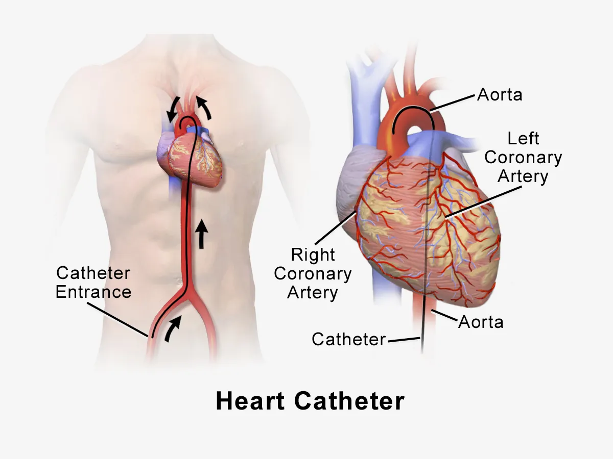 Coronary Angiogram image 1