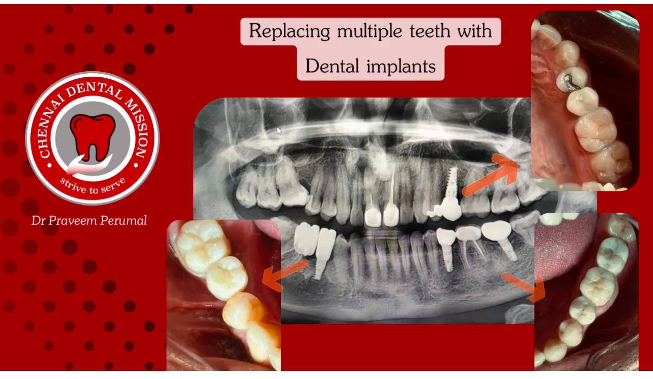 DENTAL IMPLANT image 1