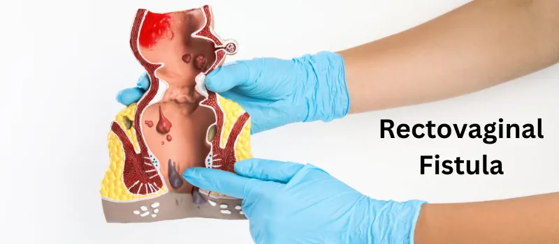 Treatment For Recto-vaginal Fistula image 1