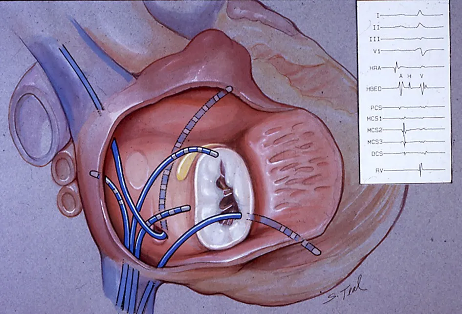 Electrophysiological Study (EP study) image 1