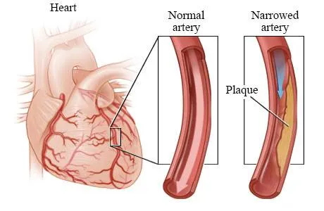 Coronary Angioplasty image 1