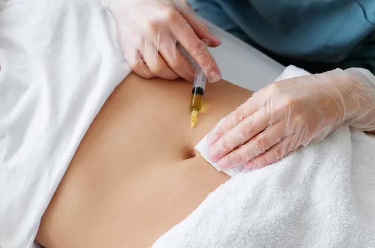 Stretch Mark Microneedling image 1