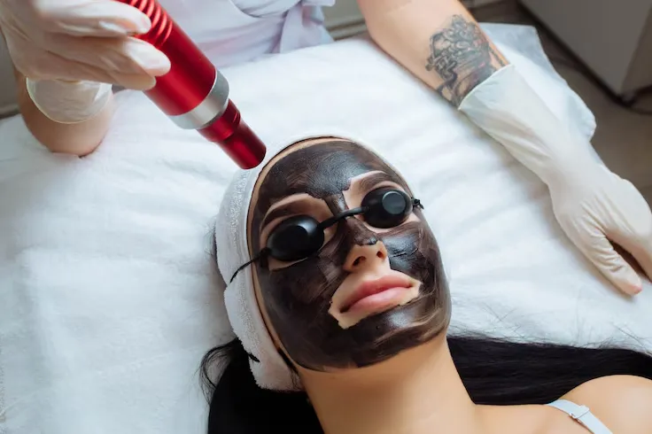 Carbon Laser Facial image 1