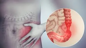 IBS Treatment in Jaipur Rajasthan image 1