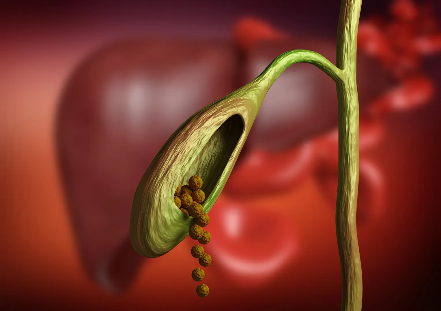 Gallbladder Surgery image 1
