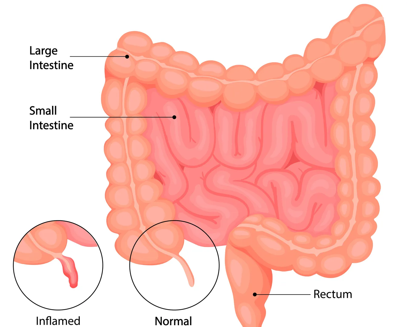 Appendix Surgery image 1