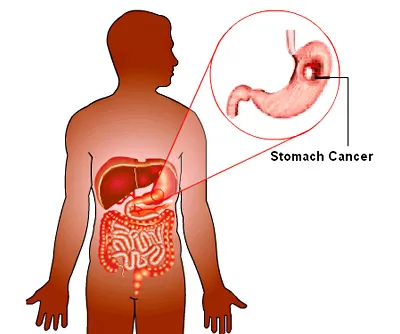 Stomach Cancer Surgery image 1