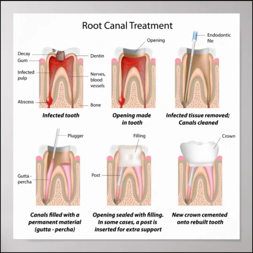 Root Canal Treatment image 1