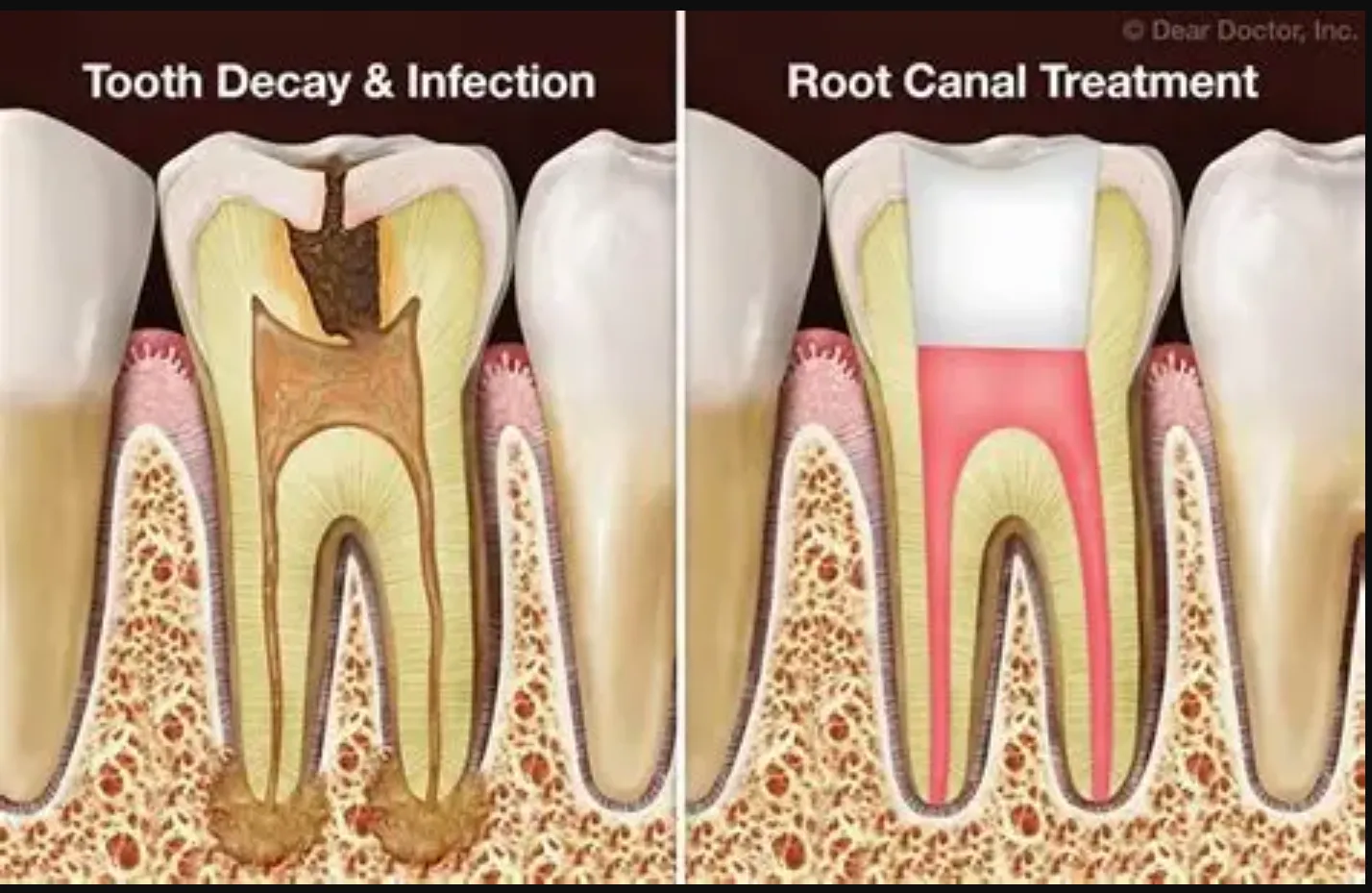 Root Canal Treatment image 2