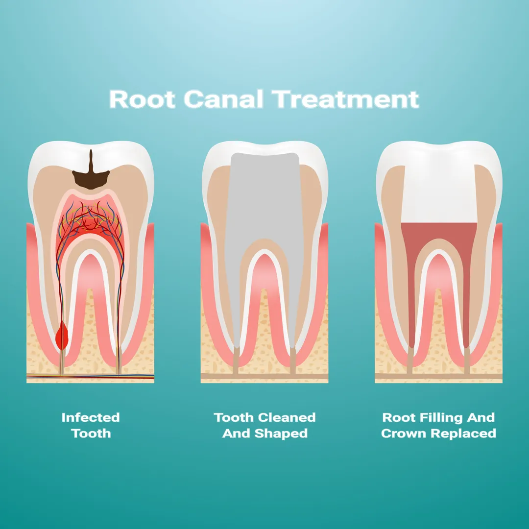 Root Canal Treatment image 3