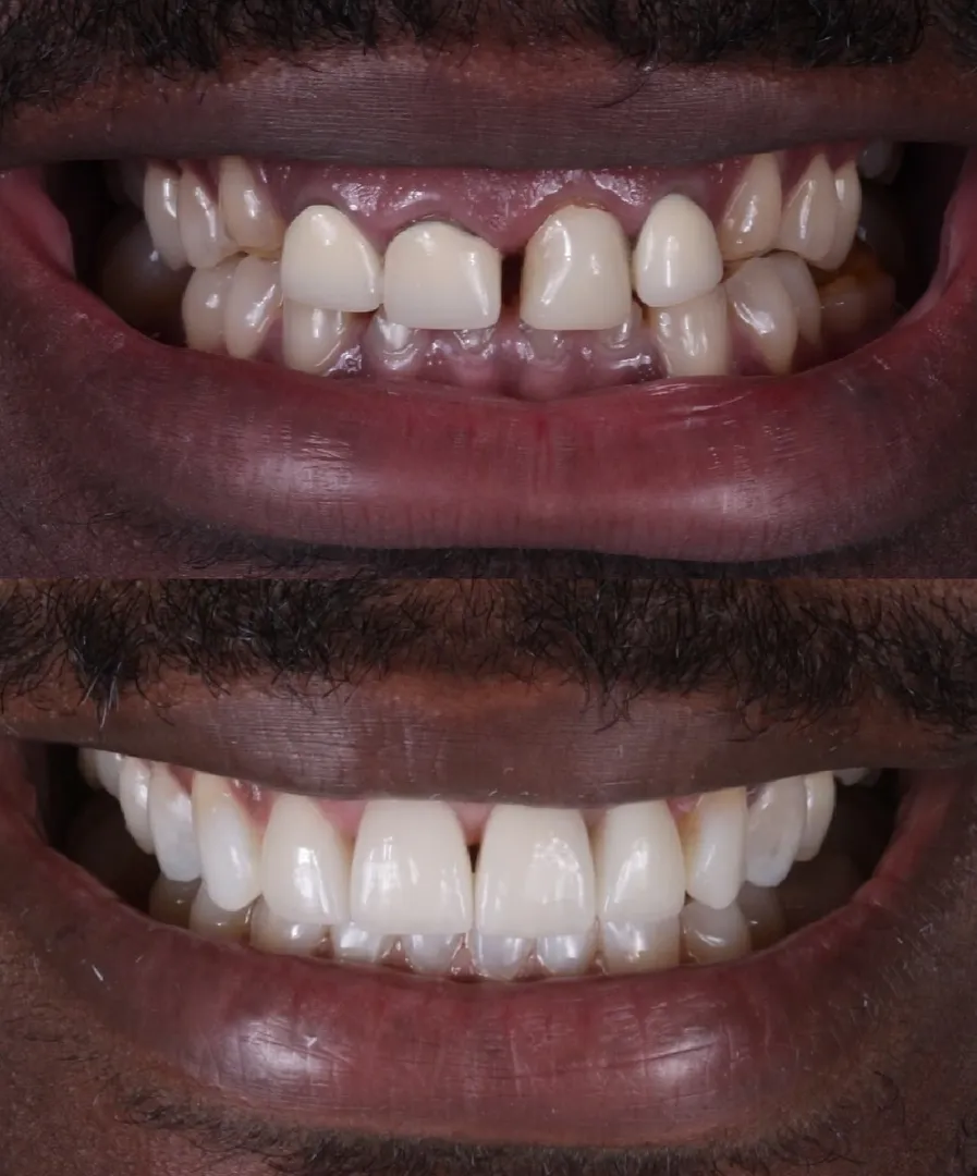 Full-Mouth Rehabilitation image 2