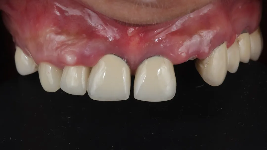 Dental Implants image 2