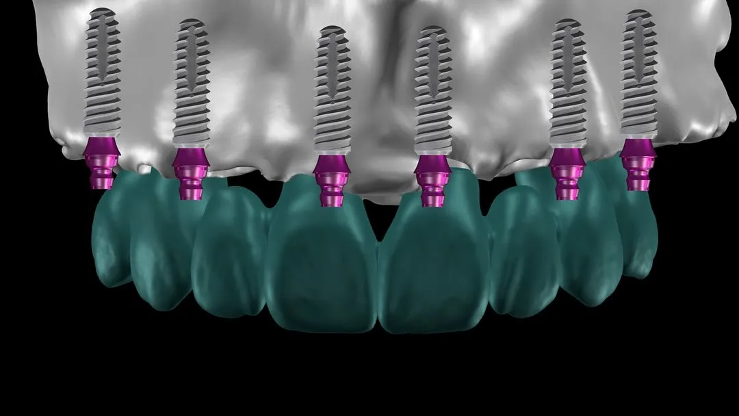 Dental Implants image 3