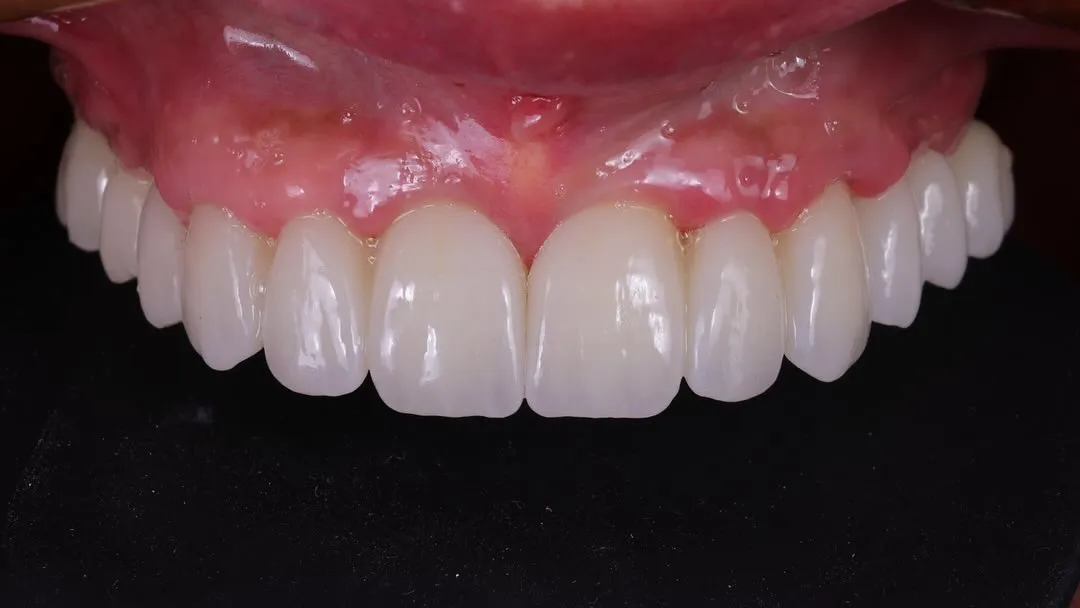 Dental Implants image 4