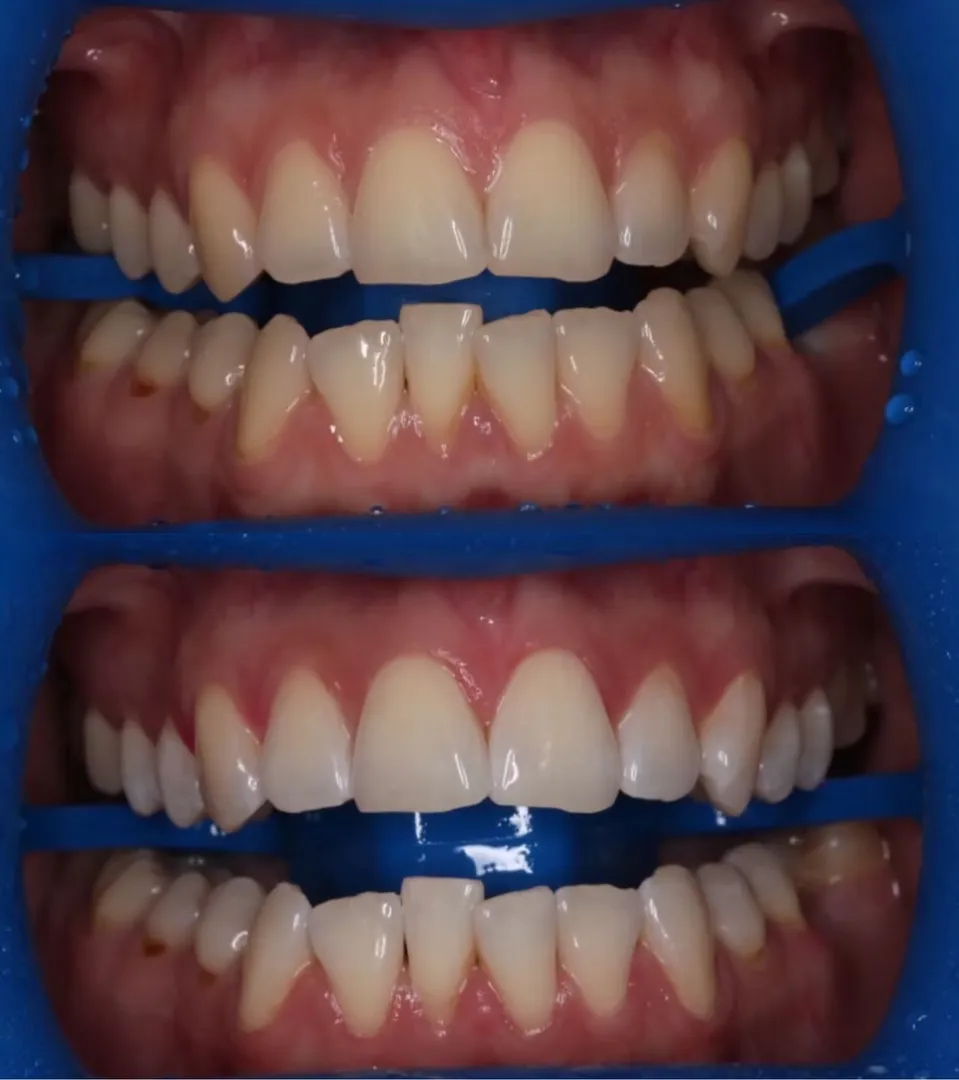 Teeth Whitening – Blancone® System image 1