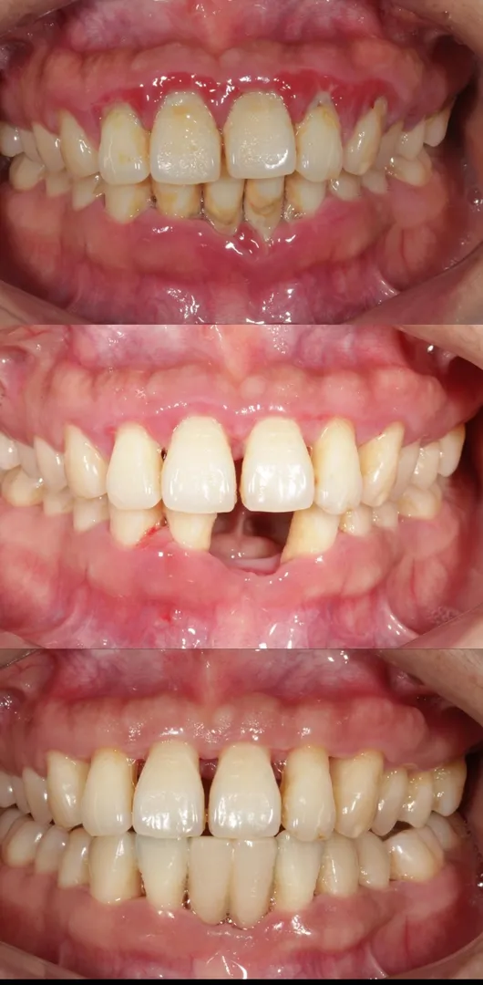 Gum Treatments (Periodontics) image 2