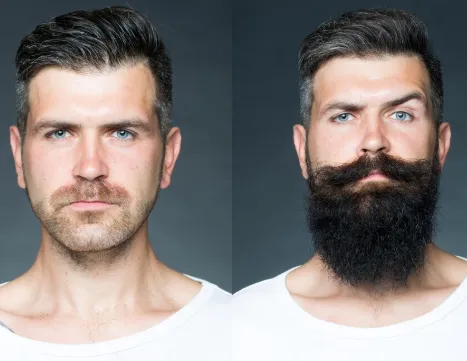 Beard Transplantation image 1