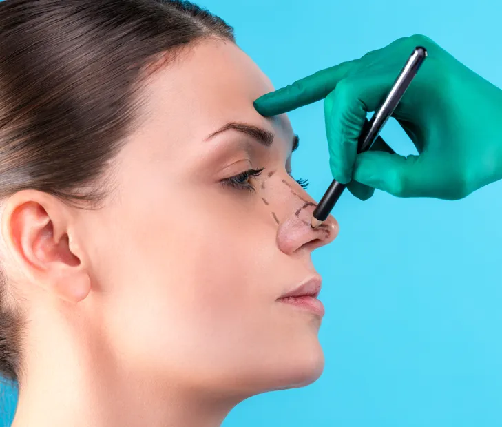 Septoplasty image 1