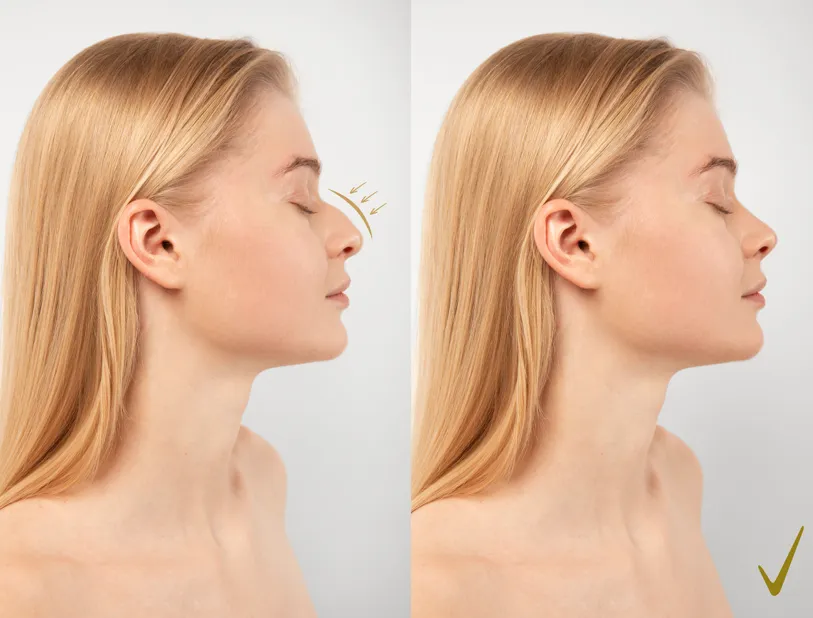 Rhinoplasty image 1