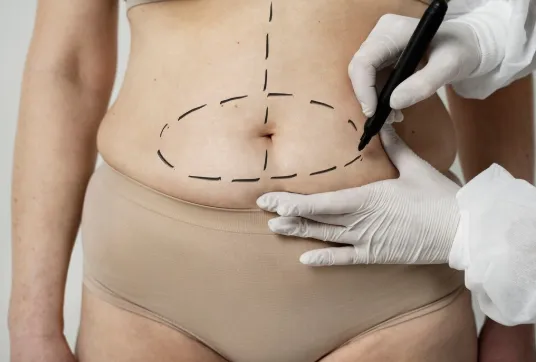 Liposuction image 1