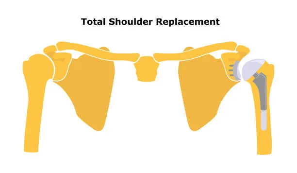 Shoulder Replacement Surgery image 1