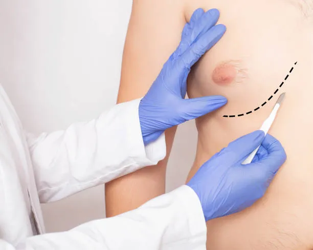 Gynaecomastia image 1