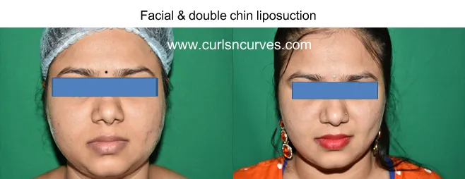 Chin Implant Surgery image 1