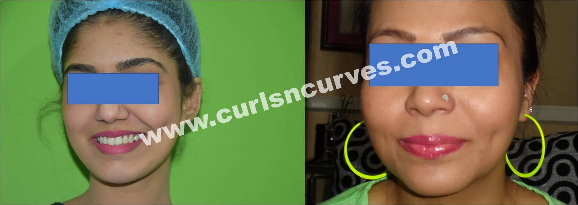 Dimple Creation Surgery image 1