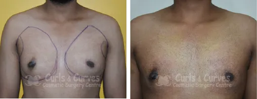 Gynecomastia Surgery image 2