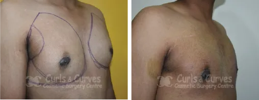 Gynecomastia Surgery image 3