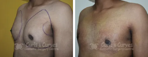 Gynecomastia Surgery image 4