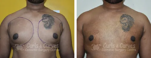 Gynecomastia Surgery image 5